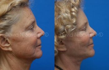 Neck Lift Before and After | Sayah Institute