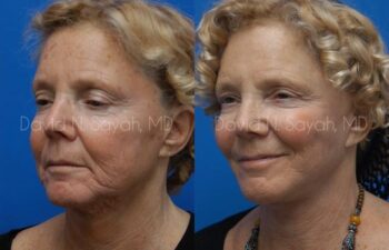 Neck Lift Before and After | Sayah Institute