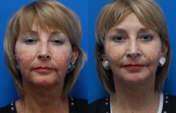 Neck Lift Before and After | Sayah Institute