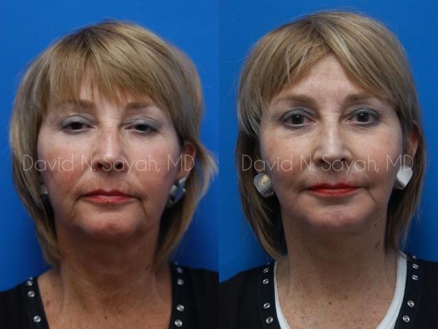 Neck Lift Before and After | Sayah Institute