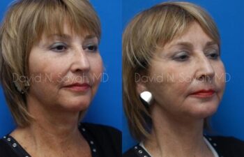 Neck Lift Before and After | Sayah Institute