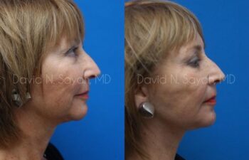 Neck Lift Before and After | Sayah Institute