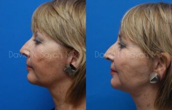 Neck Lift Before and After | Sayah Institute