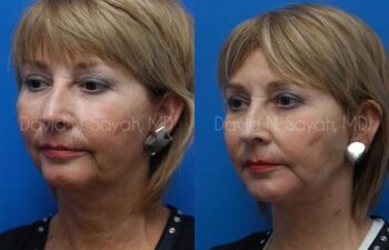 Neck Lift Before and After | Sayah Institute