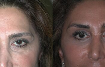 Endoscopic Brow Lift Before and After | Sayah Institute