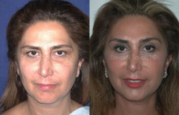 Endoscopic Brow Lift Before and After | Sayah Institute