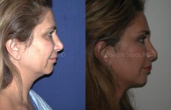 Endoscopic Brow Lift Before and After | Sayah Institute