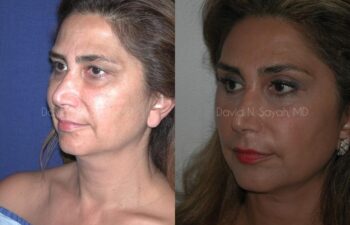 Endoscopic Brow Lift Before and After | Sayah Institute