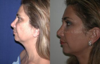 Endoscopic Brow Lift Before and After | Sayah Institute