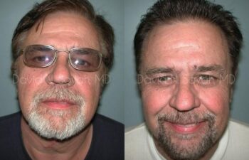 Neck Lift Before and After | Sayah Institute
