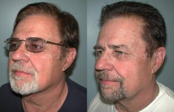 Neck Lift Before and After | Sayah Institute