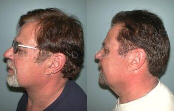 Neck Lift Before and After | Sayah Institute