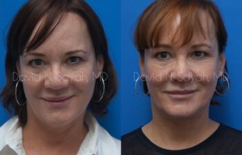 Neck Lift Before and After | Sayah Institute