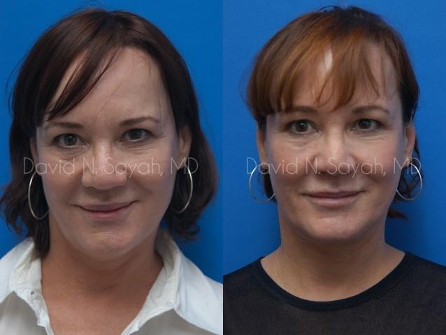 Neck Lift Before and After | Sayah Institute