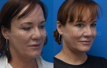 Neck Lift Before and After | Sayah Institute