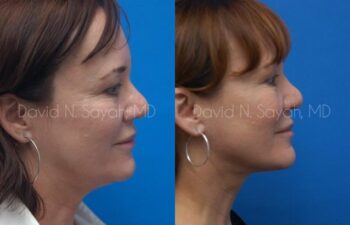 Neck Lift Before and After | Sayah Institute