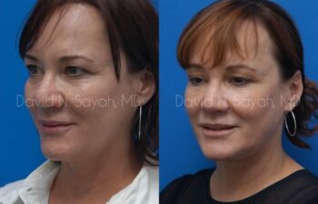 Neck Lift Before and After | Sayah Institute