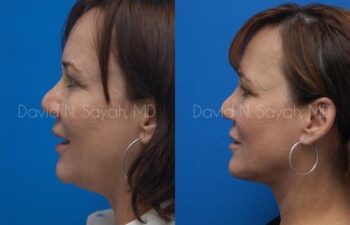 Neck Lift Before and After | Sayah Institute