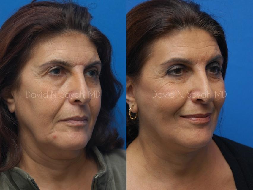 Neck Lift Before and After | Sayah Institute