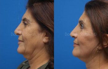 Neck Lift Before and After | Sayah Institute