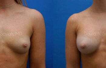 Breast Augmentation Before and After | Sayah Institute