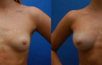 Breast Augmentation Before and After | Sayah Institute