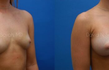 Breast Augmentation Before and After | Sayah Institute