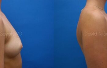 Breast Augmentation Before and After | Sayah Institute