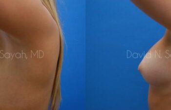 Breast Augmentation Before and After | Sayah Institute
