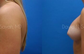 Breast Augmentation Before and After | Sayah Institute