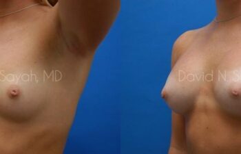 Breast Augmentation Before and After | Sayah Institute
