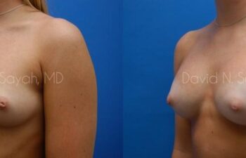 Breast Augmentation Before and After | Sayah Institute