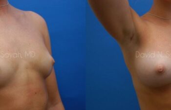 Breast Augmentation Before and After | Sayah Institute