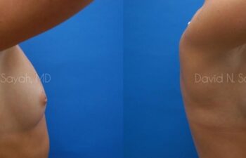 Breast Augmentation Before and After | Sayah Institute