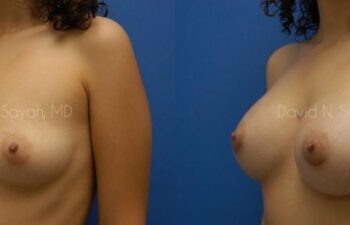 Breast Augmentation Before and After | Sayah Institute