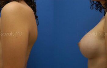 Breast Augmentation Before and After | Sayah Institute