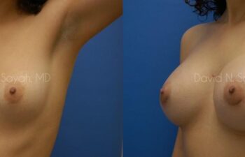 Breast Augmentation Before and After | Sayah Institute
