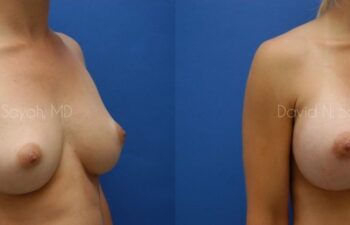 Breast Augmentation Before and After | Sayah Institute