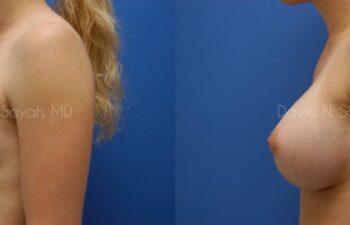 Breast Augmentation Before and After | Sayah Institute