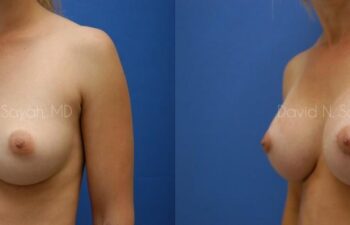 Breast Augmentation Before and After | Sayah Institute