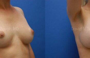 Breast Augmentation Before and After | Sayah Institute