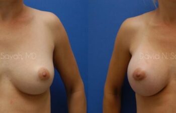 Breast Augmentation Before and After | Sayah Institute