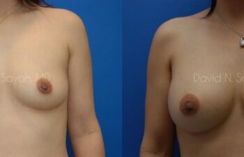 Breast Augmentation Before and After | Sayah Institute