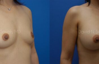 Breast Augmentation Before and After | Sayah Institute
