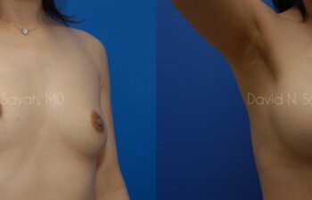 Breast Augmentation Before and After | Sayah Institute