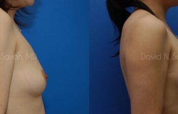 Breast Augmentation Before and After | Sayah Institute