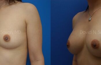 Breast Augmentation Before and After | Sayah Institute