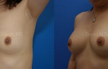 Breast Augmentation Before and After | Sayah Institute