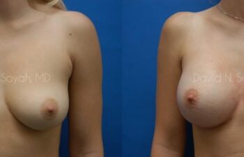 Breast Augmentation Before and After | Sayah Institute