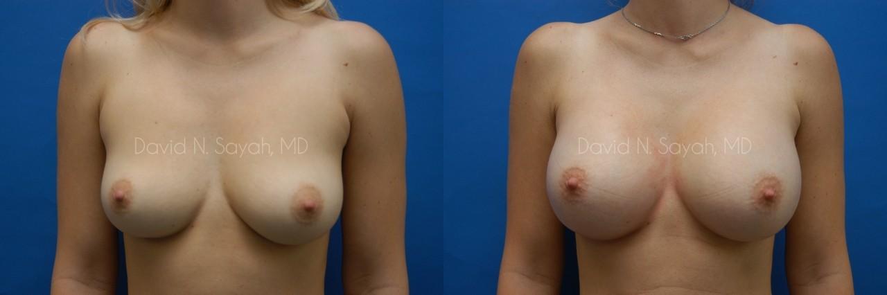 Breast Augmentation Before and After | Sayah Institute